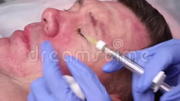 医生在病人脸上划了一个穴位注射生物资本化的准备接近视频的预览图