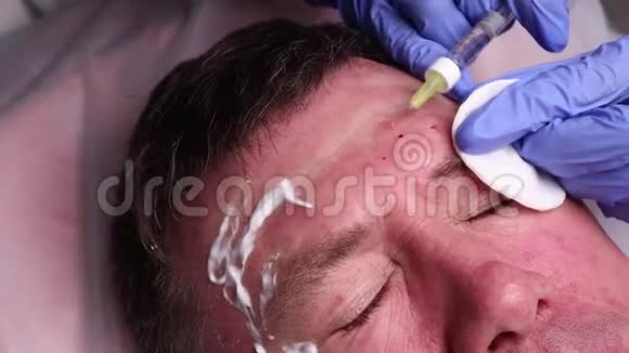 整形外科医生的手在病人脸上画轮廓用于面部轮廓整形的手术视频的预览图