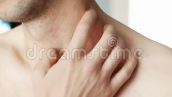 男人的脖子上抓着一个红色的皮疹过敏和皮肤病视频的预览图