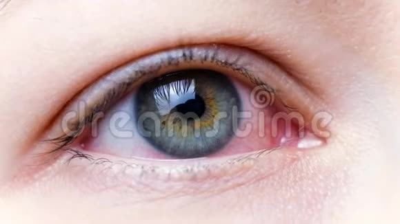 一只严重的红眼病毒性出血结膜炎腺病毒眼睛受到刺激或感染视频的预览图