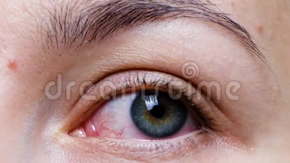 一只严重的红眼病毒性出血结膜炎腺病毒眼睛受到刺激或感染视频的预览图