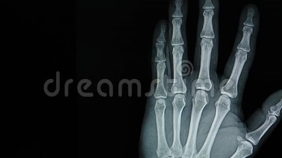 手部骨折骨的x射线运动图像视频的预览图