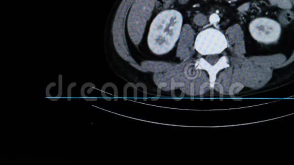 病人全腹CT扫描或计算机断层扫描视频的预览图