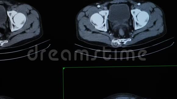 病人全腹CT扫描或计算机断层扫描视频的预览图