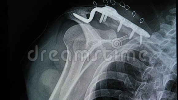 锁骨骨折患者X线片视频的预览图