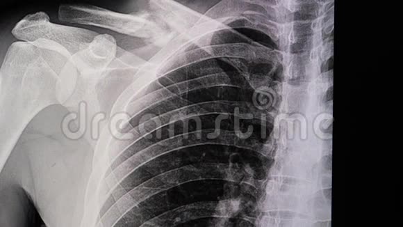 锁骨骨折患者的X线片视频的预览图