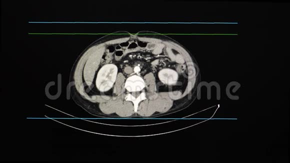 人全腹CT扫描或计算机断层扫描视频的预览图