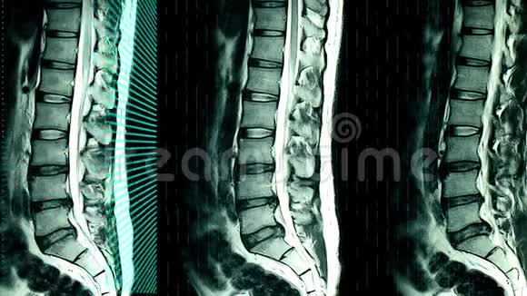 患者腰骶部MRI扫描视频的预览图