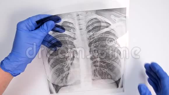 一名戴蓝色手套的医生的手检查检查荧光成像一名在流行病肺炎和支气管炎期间的病人的x光视频的预览图