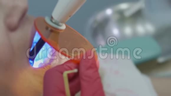 牙医对病人进行光聚合物填充视频的预览图