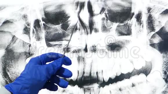 颌骨和鼻窦的全景断层扫描医生他的手在屏幕上显示了一个x射线视频的预览图