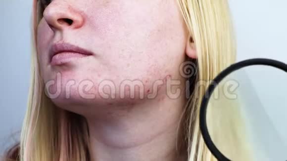 后痤疮在放大镜皮肤有痤疮疤痕与皮肤科医生约会的女人视频的预览图