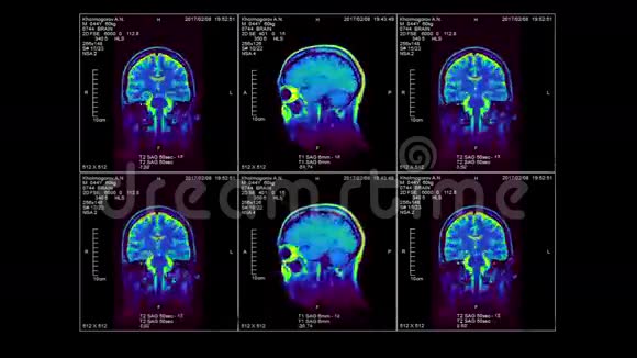 三维脑MRI视频回路通道视频的预览图