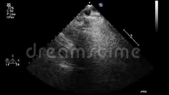 心脏超声经食管检查视频的预览图