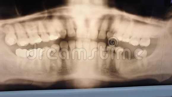 中老年人全景牙科X射线照片显示闪烁效果降低视频的预览图
