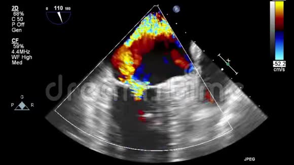 经食管超声检查心脏图像视频的预览图