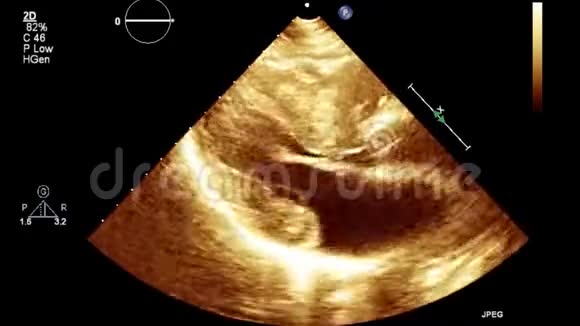 经食管超声检查心脏图像视频的预览图