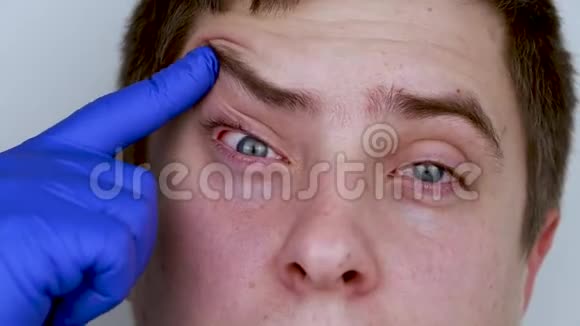 医生药剂师用蓝色医用手套检查病人眼睛眼和角膜护理概念怀疑结膜炎视频的预览图