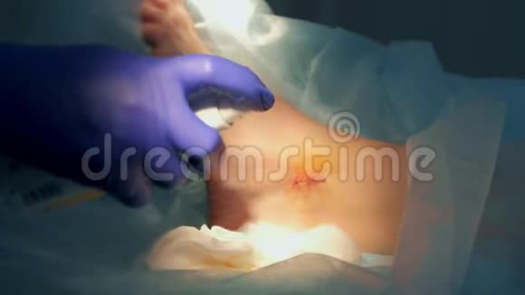 外科医生在手术后对患者踝关节缝合处喷洒碘防腐剂视频的预览图