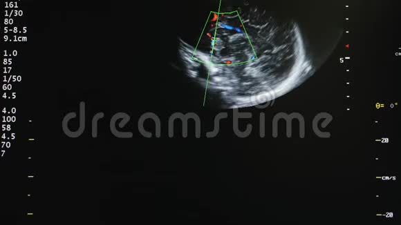 新生儿心脏超声检查视频的预览图