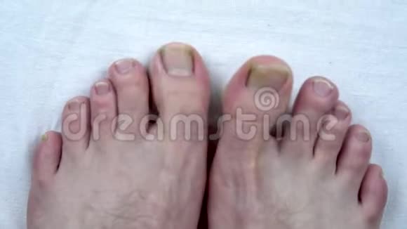 带有真菌的大的未切趾甲这个人有黄色的脚趾甲很久没剪指甲了视频的预览图