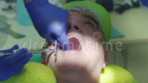 减速除牙工序关闭牙科医生的手去除病牙视频的预览图