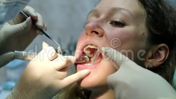 去看牙医一位牙医正在为一个戴牙套的女孩钻牙口腔学家制造了一块海豹视频的预览图