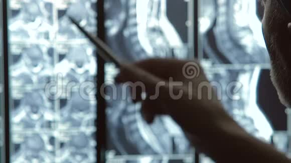 专业外科医生检查受伤脊柱扫描图像仔细观察视频的预览图