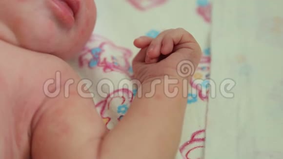 在医院的床上躺着一个皮肤过敏的新生儿的特写视频的预览图