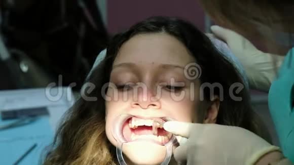 牙医把棉花放进嘴里助手在安装之前从唾液喷射器中取出唾液视频的预览图