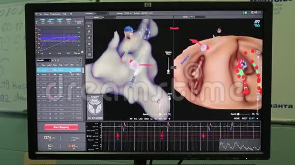 3显示器上心脏的投影视频的预览图