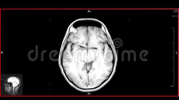 脑顶MRT扫描视频的预览图