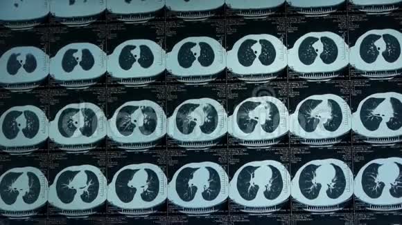 动肺部petct扫描医学X线视频的预览图