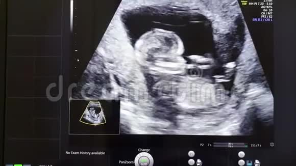 母亲子宫内婴儿超声检查视频的预览图