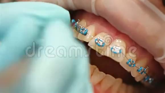 牙医把口香糖固定在Braces上视频的预览图