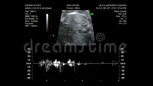 婴儿超声心电图视频的预览图