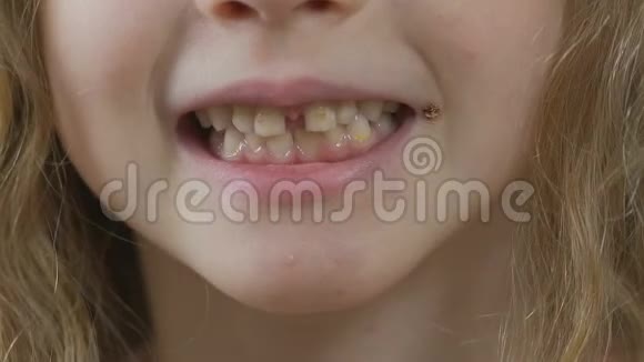 小孩微笑着露出牙床和牙齿有龋齿黄斑视频的预览图