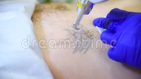 美容医生移除纹身病人专业激光视频的预览图