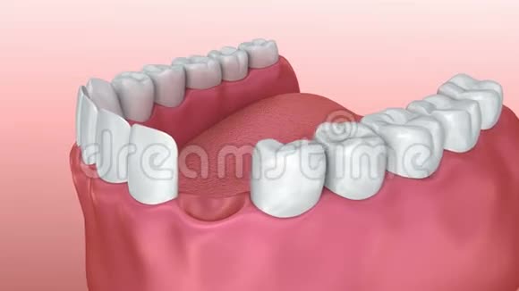 牙种植体安装工艺医学精确视频的预览图