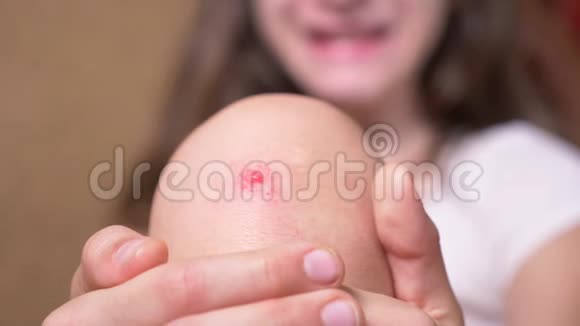 孩子受伤的膝盖女孩膝盖上擦伤特写镜头在磨损处倒入碘4k慢动作视频的预览图