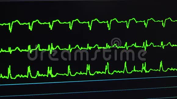 手术室心脏监视器的工作视频的预览图