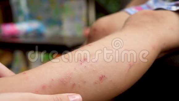蚊虫叮咬对小女孩腿部皮肤的损害视频的预览图