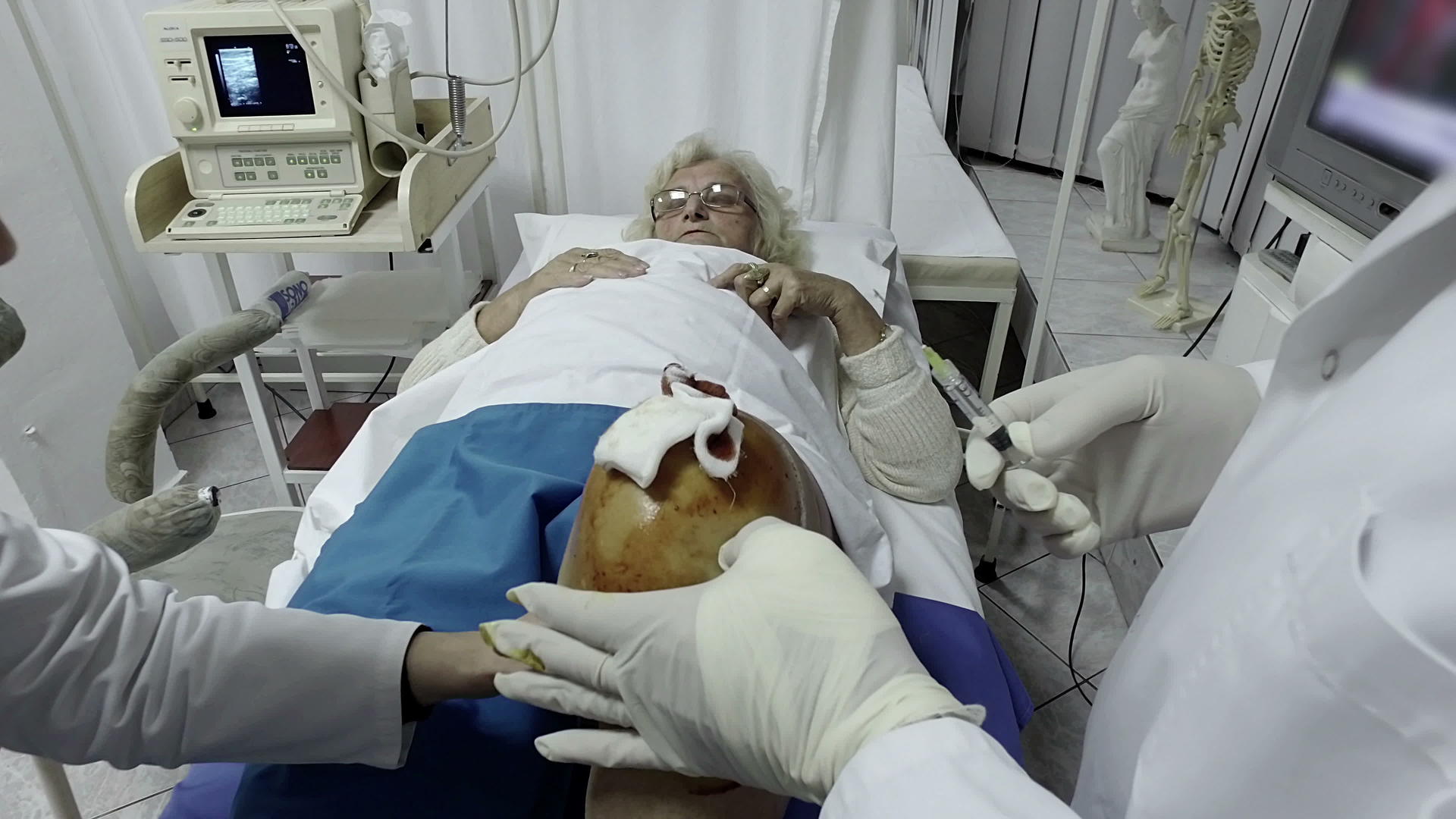 膝关节撕裂乳性骨髓结膜动脉透镜医院急诊手术室视频的预览图