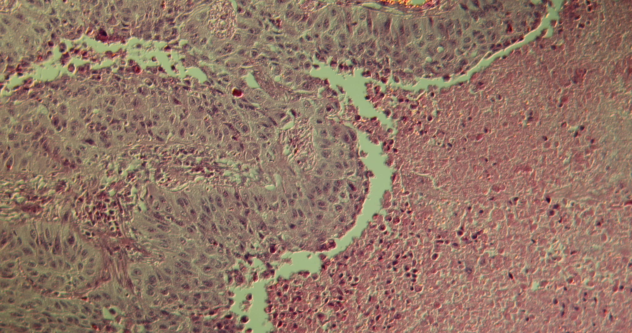 肺部二次细胞癌视频的预览图