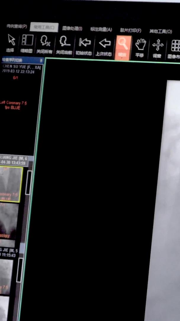 患者血管造影手术前后对比视频的预览图