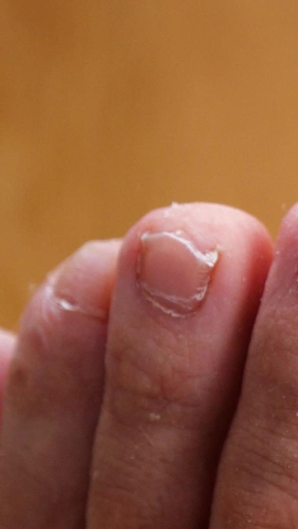 脚气灰指甲皮肤病皮肤干裂视频的预览图