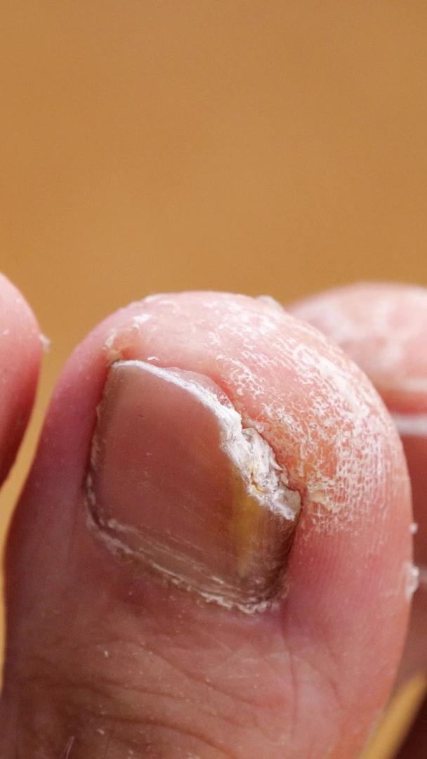 脚气灰指甲皮肤病皮肤干裂视频的预览图
