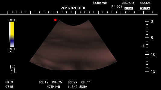医学彩超框肾内科腹腔边框视频的预览图
