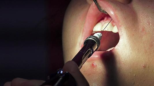 牙医在口腔手术前用注射器对牙齿进行消毒视频的预览图