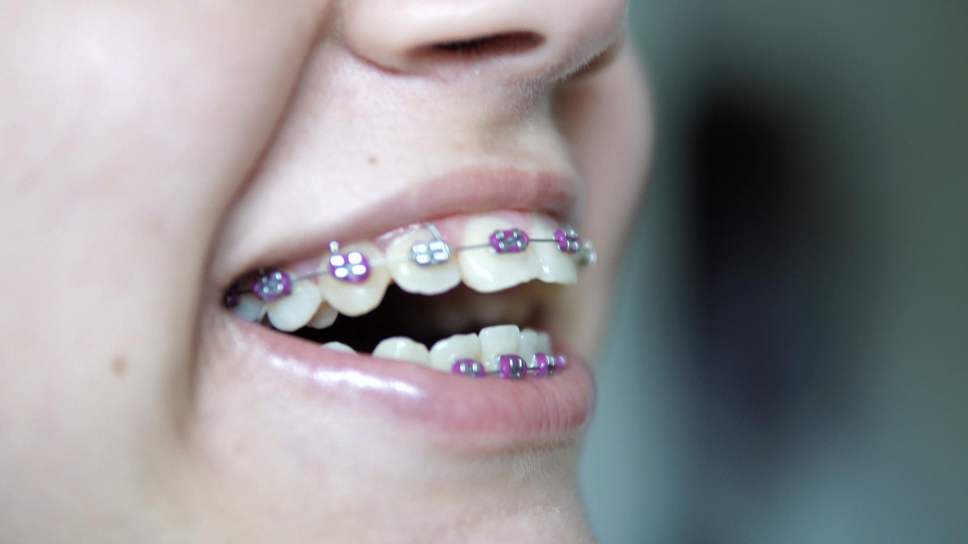 可爱的孩子的肖像牙齿牙套微笑视频的预览图
